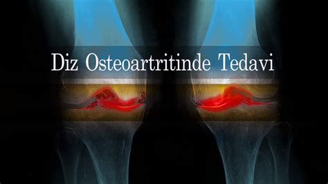 diz osteoartritinde akut ağrı nasıl giderilir
